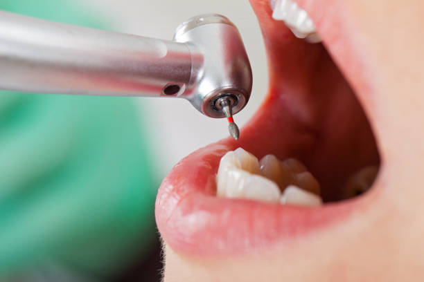 Best Emergency Wisdom Teeth Removal in Chandler, OK